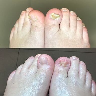 Опит в използването на барни с крем Promicil от Израел, снимка преди и след