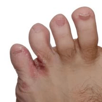 Гъбички между пръстите