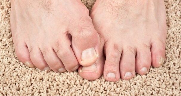 Симптоми на гъбички за нокти