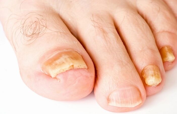 Гъбичката на палеца на крака