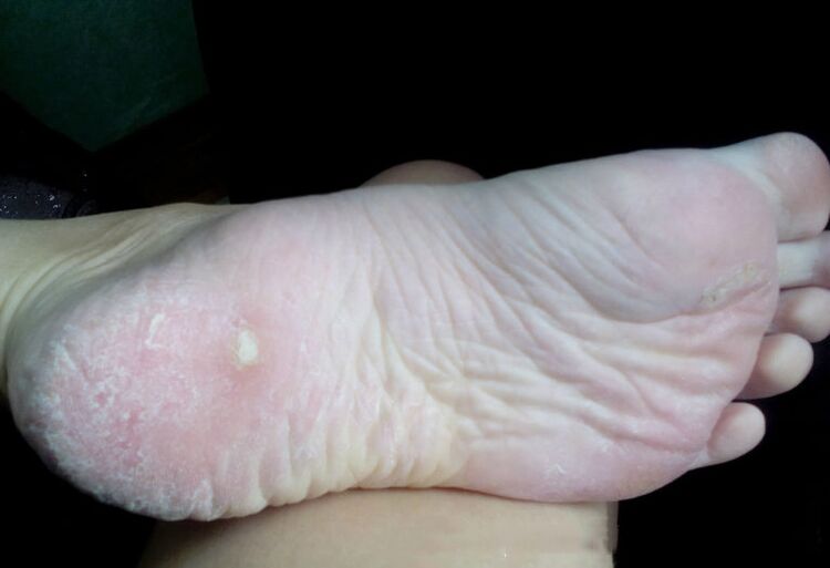 Лечение на гъбичката с лазер