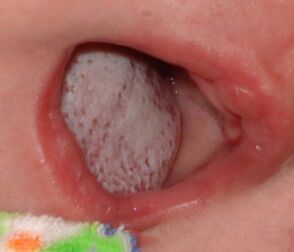 Локализация на болестта с гъбичка