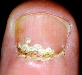 Симптоми и признаци на заболяването