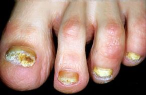 Характеристика на болестта