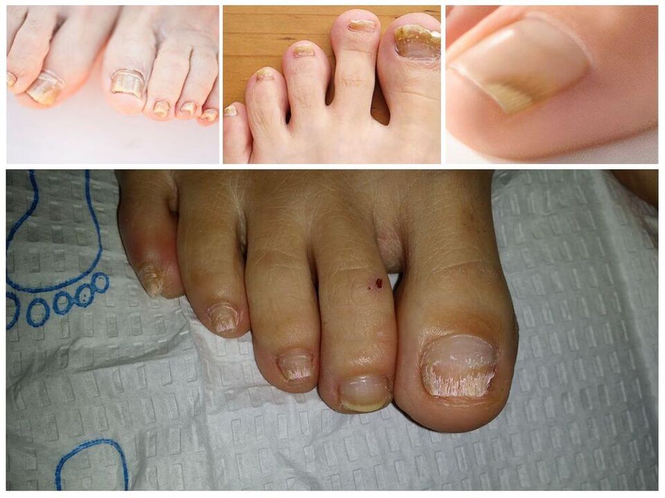 Гъбични заболявания на нокътните плочи