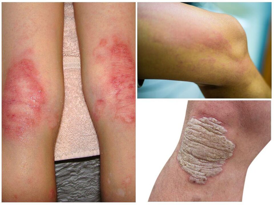 Гъбични инфекции на колената