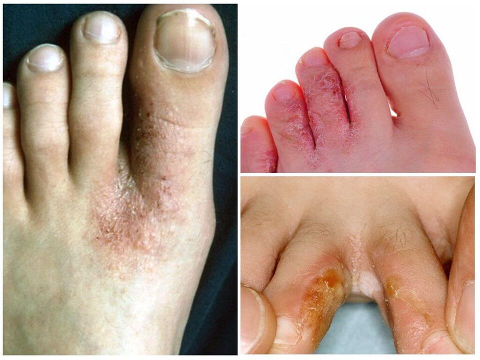 Интердигитална микоза