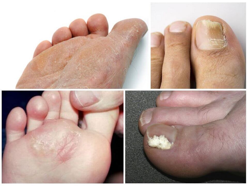 Начален стадий на гъбички по краката