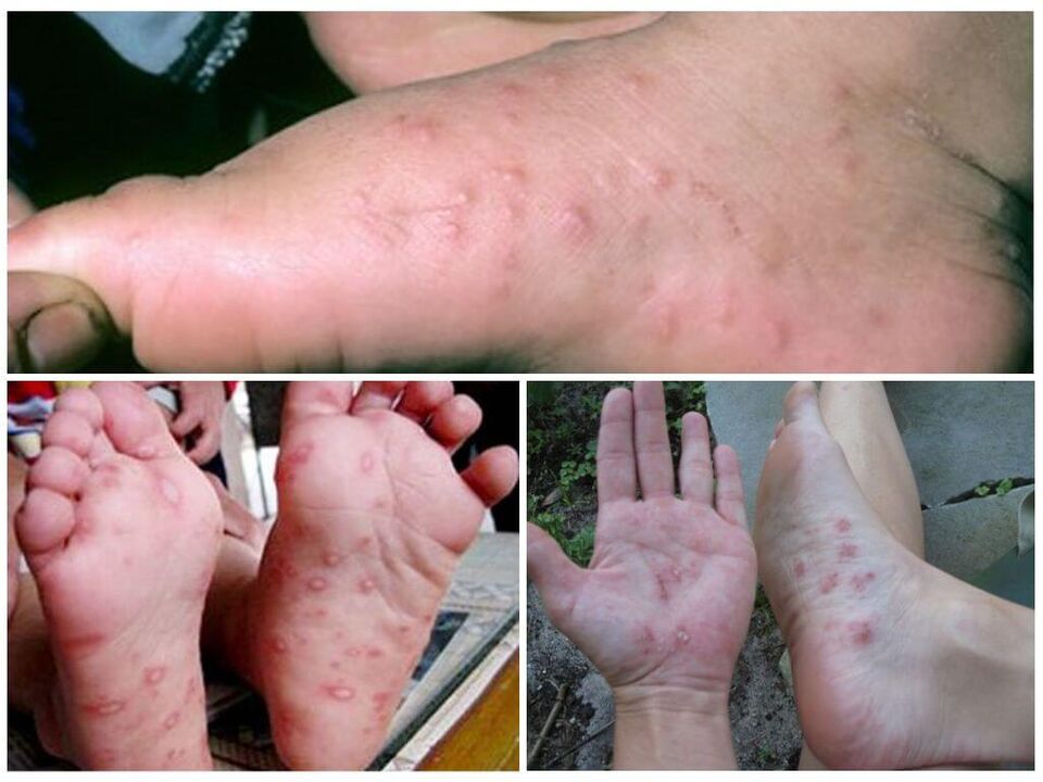 Хиперкератозни лезии на краката