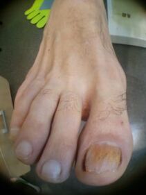 гъбички по ноктите на големия пръст