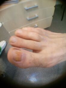 начален стадий на гъбички по ноктите на големия пръст