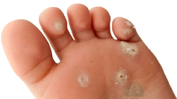 втори етап на гъбична инфекция