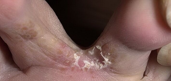 гъбички между пръстите на краката