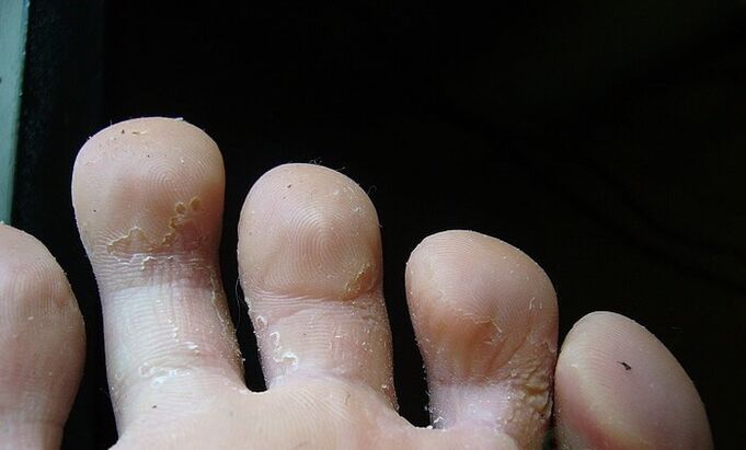 начален стадий на гъбички